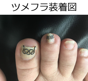 ツメフラ法