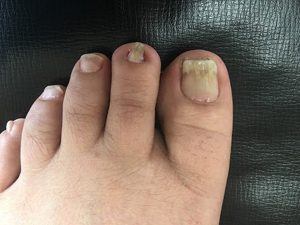 矯正後