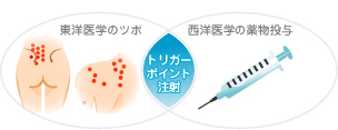 トリガーポイント注射
